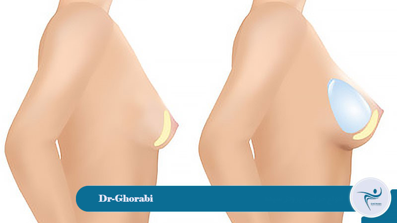 Types of breast prosthesis surgery
