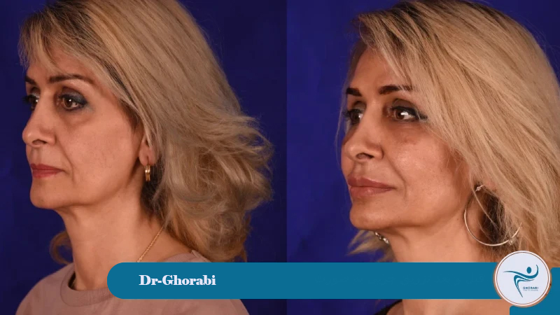  Facial Lipofilling