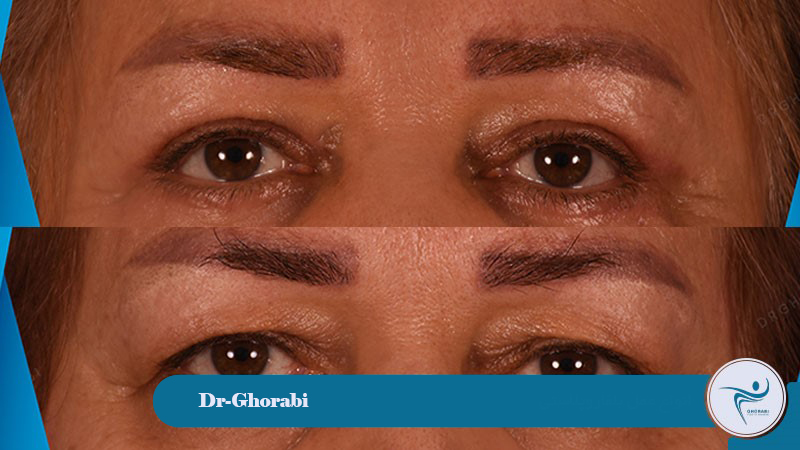 Types of blepharoplasty surgery
