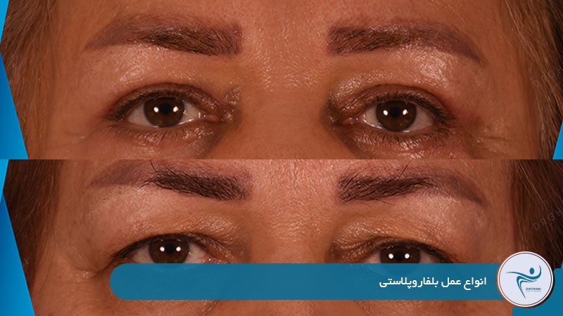 انواع عمل بلفاروپلاستی 