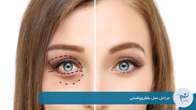 مراحل عمل بلفاروپلاستی 