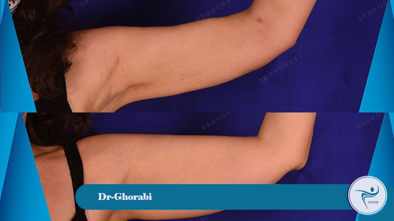 Brachioplasty