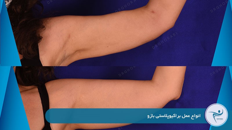 انواع عمل براکیوپلاستی بازو 