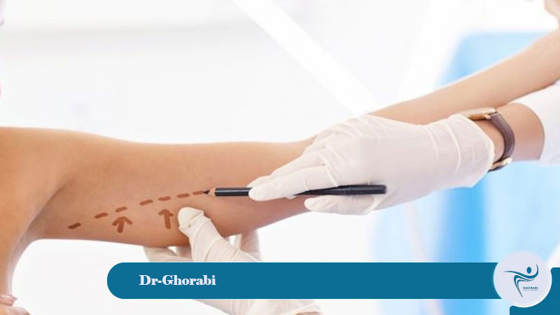 Brachioplasty