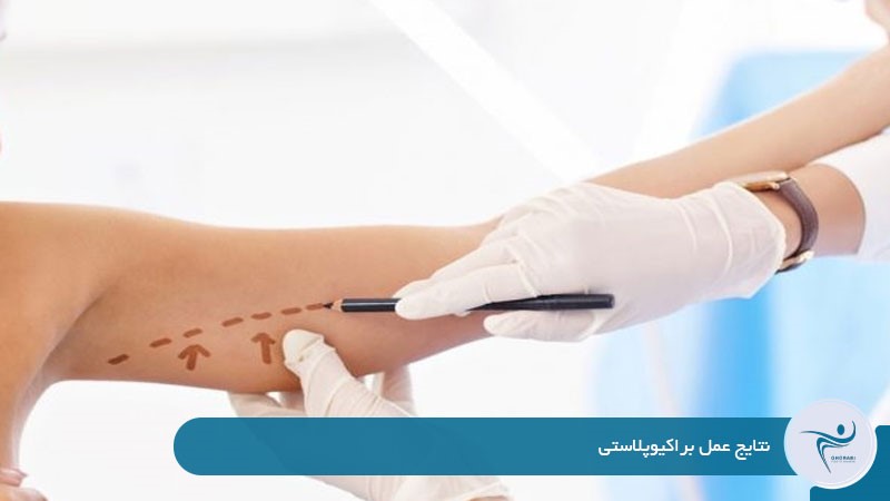 نتایج عمل براکیوپلاستی 