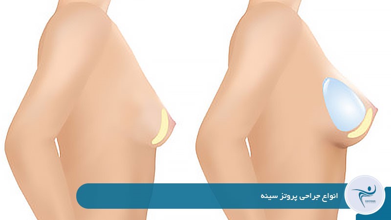 انواع جراحی پروتز سینه 