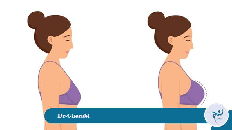 Post-breast prosthesis care
