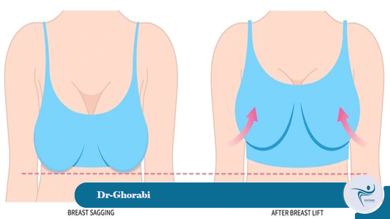 The best candidate for breast lift surgery
