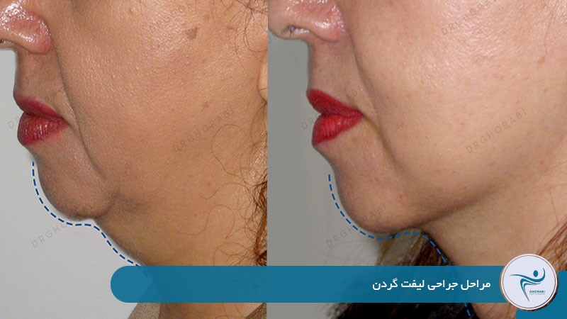 مراحل جراحی لیفت گردن 