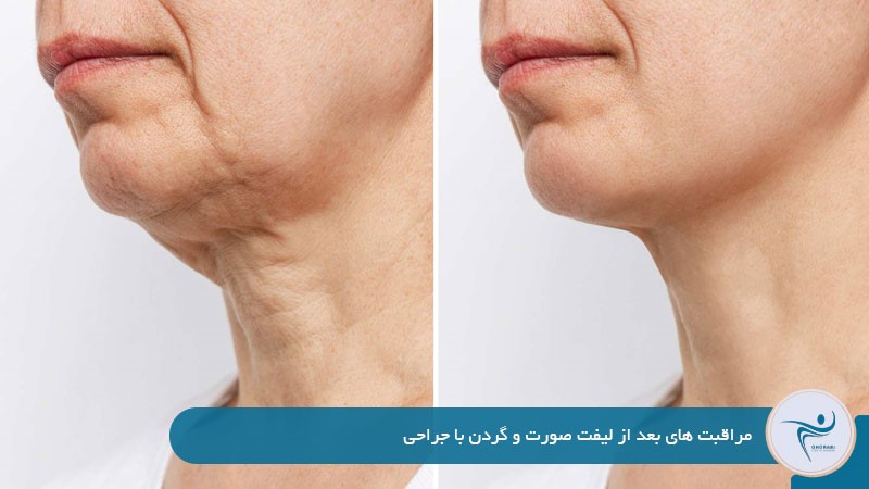 مراقبت‌های بعد از لیفت صورت و گردن با جراحی 