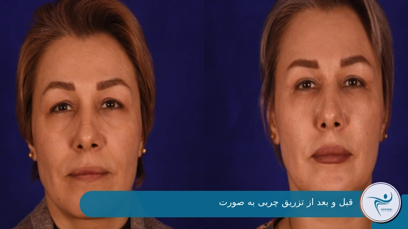 قبل و بعد از تزریق چربی به صورت