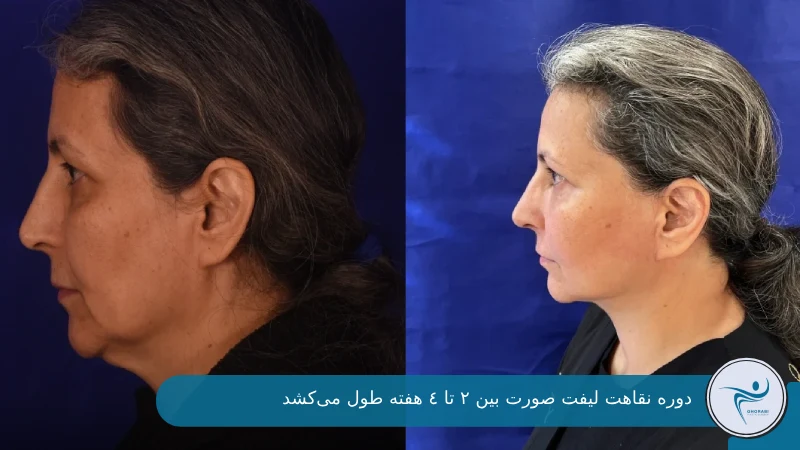 قبل و بعد از عمل لیفت صورت