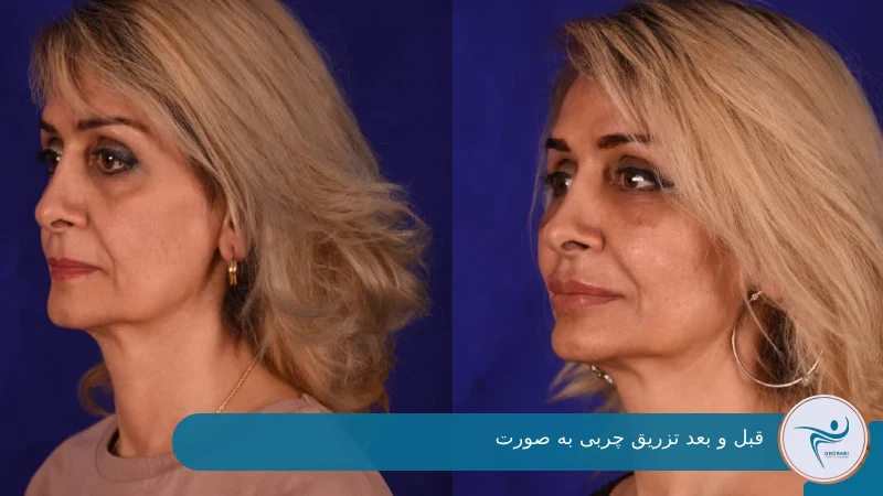 قبل و بعد تزریق چربی صورت دکتر غرابی