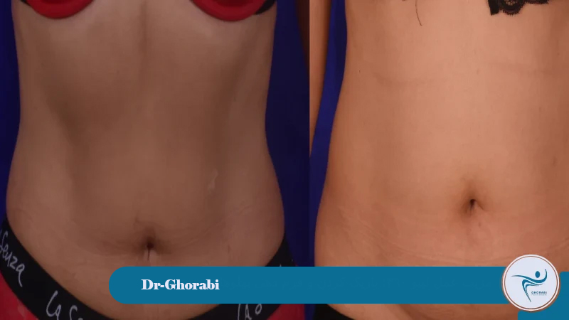 lipo 360