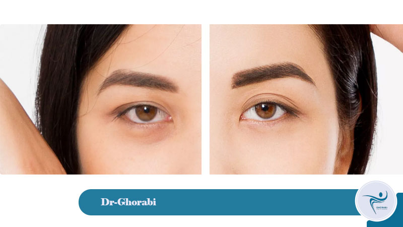 brow lifting 