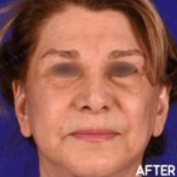 after image