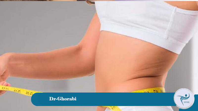 Abdominoplasty1