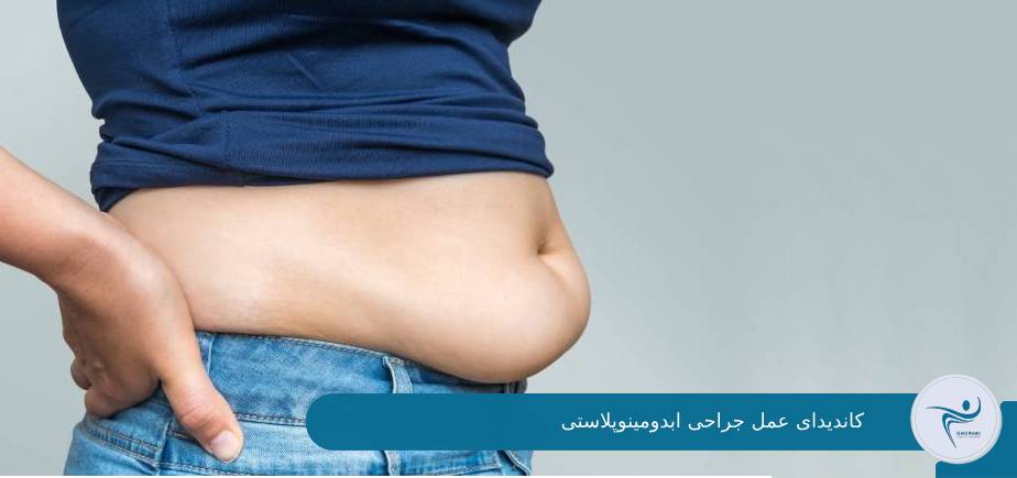 کاندیدای عمل ابدومینوپلاستی