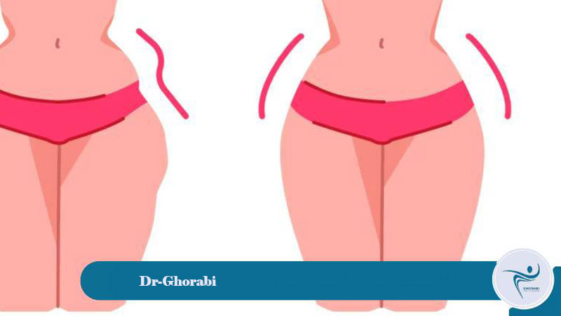 buttock augmentation