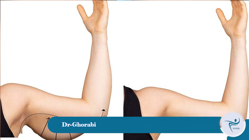 Non-surgical methods for arm lift 