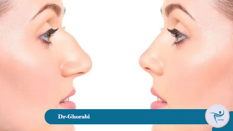 How bony rhinoplasty works