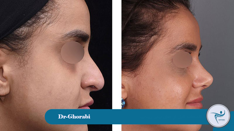 and bony rhinoplasty should be followed. 