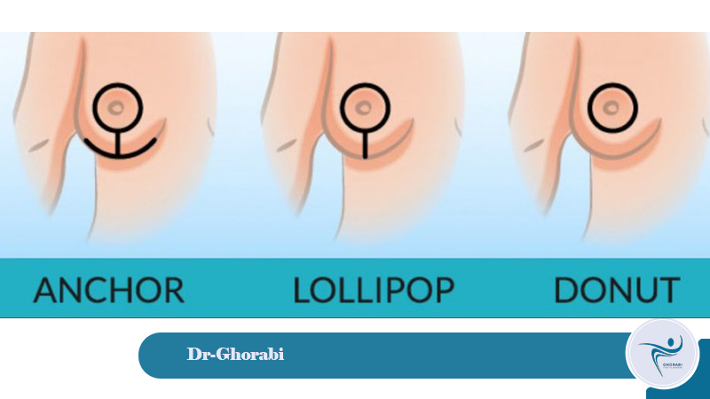 mammoplasty surgery