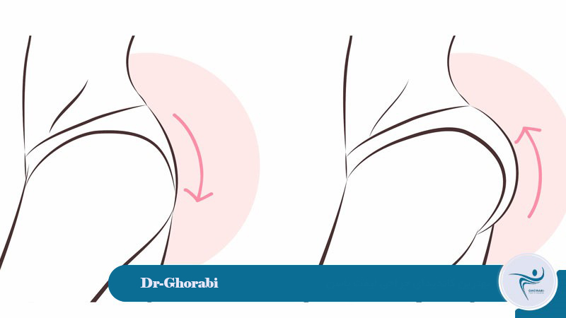 The best candidate for buttock lift surgery 