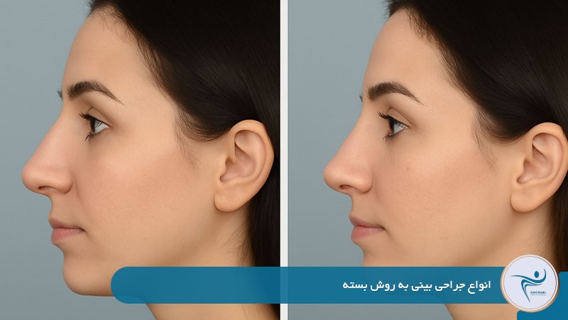انواع جراحی بینی به روش بسته 