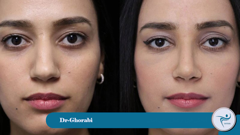 Preparation Before Closed Rhinoplasty 
