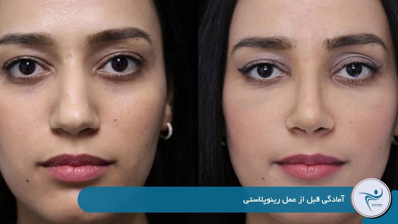 آمادگی قبل از عمل رینوپلاستی بسته 