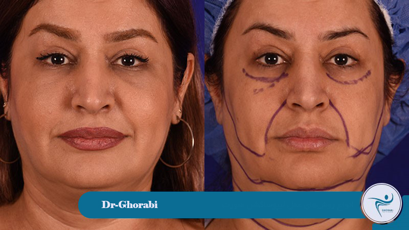 liposuction