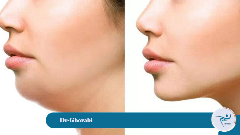 liposuction