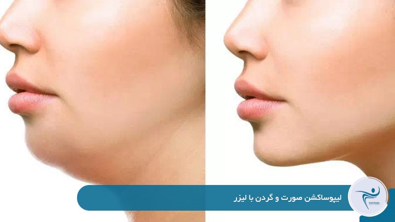 لیپوساکشن صورت و گردن با لیزر 