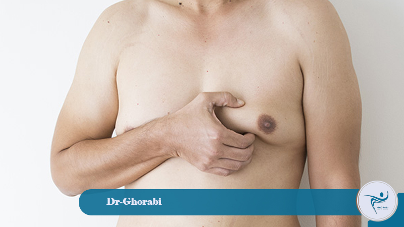 Gynecomastia