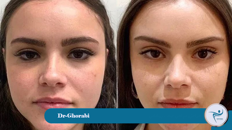 forehead lift