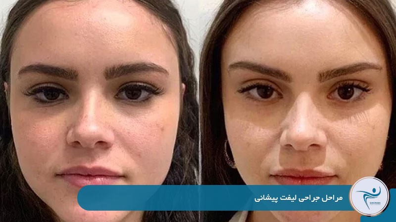 لیفت پیشانی