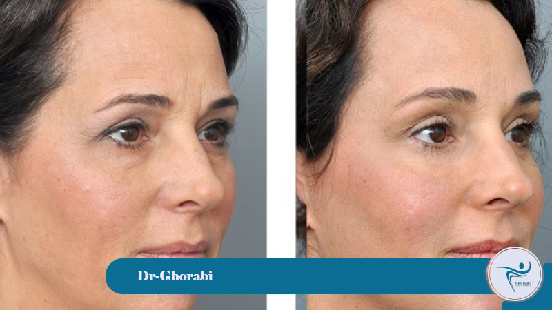 forehead lift