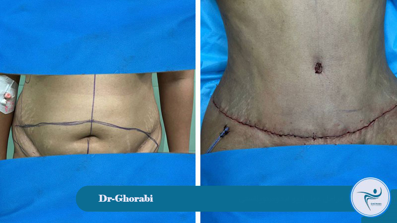 abdominoplasty