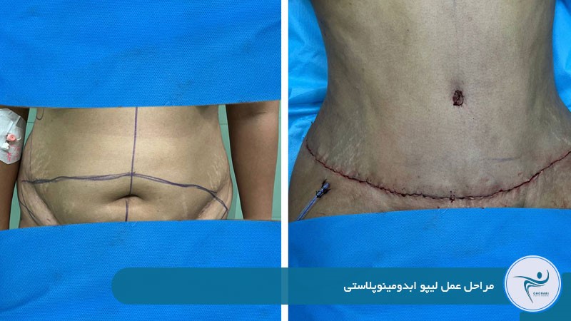 مراحل عمل لیپو ابدومینوپلاستی 