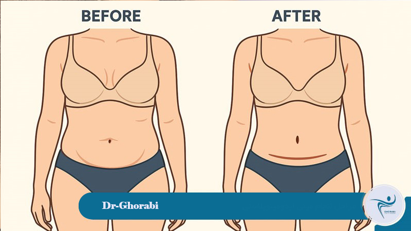 Stages of Mini-Abdominoplasty 