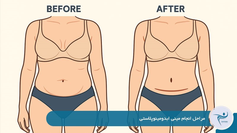 مراحل انجام مینی ابدومینوپلاستی 