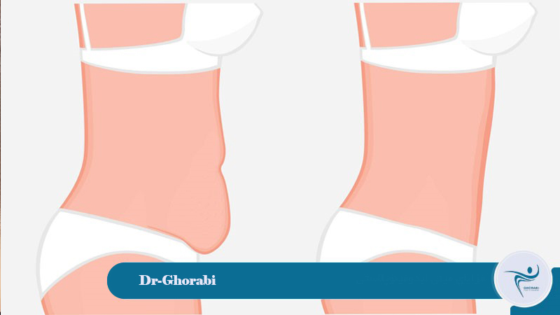 Advantages of mini-abdominoplasty 