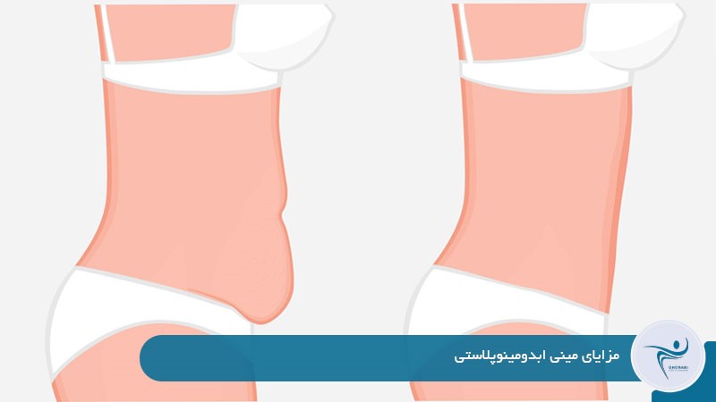 مزایای مینی ابدومینوپلاستی 