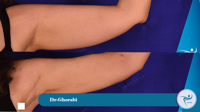 Non-surgical arm lift with HIFU 