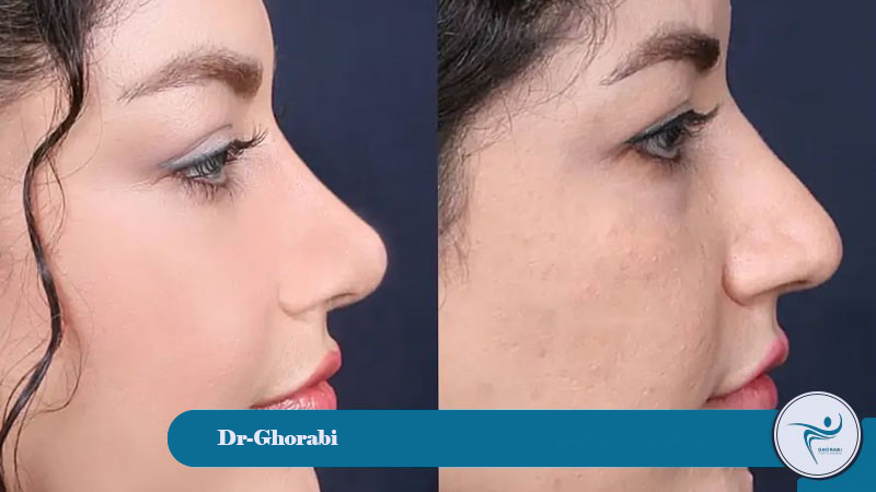 Natural rhinoplasty without a dorsal hump 