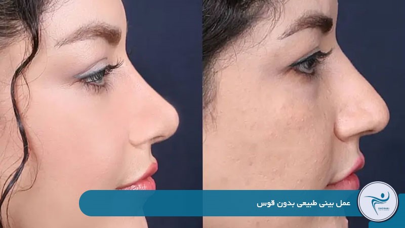 عمل بینی طبیعی بدون قوس 