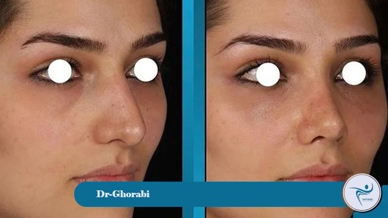 Post-operative care for natural rhinoplasty. 