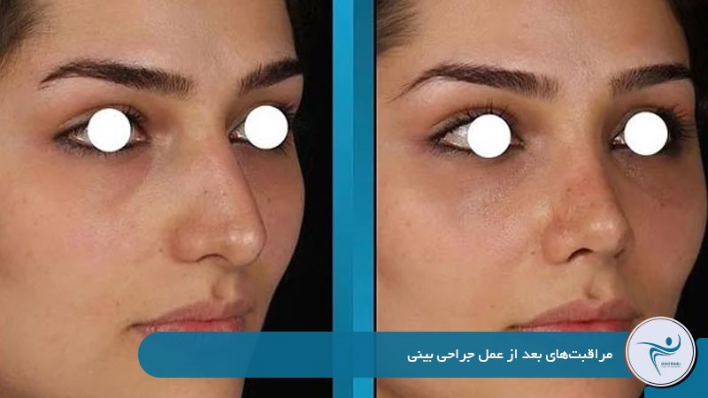 مراقبت‌های بعد از عمل جراحی بینی طبیعی 
