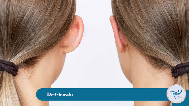 Otoplasty